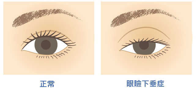 眼瞼下垂の症状イラスト