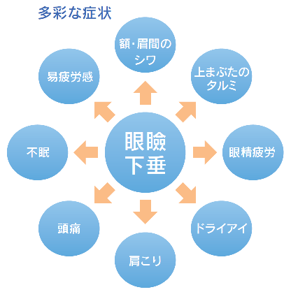 眼瞼下垂が引き起こす自覚症状イラスト