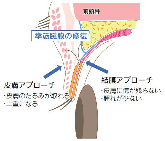 眼瞼下垂手術イラスト