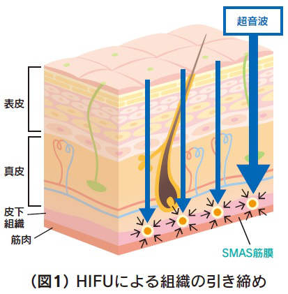 HIFU作用組織イラスト
