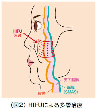 HIFU作用顔断面イラスト