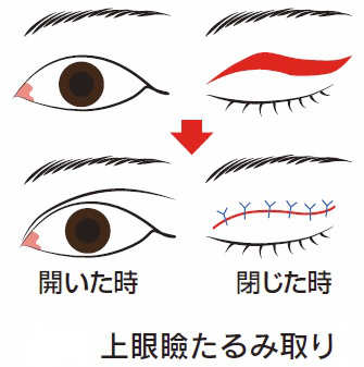 上眼瞼たるみ取りイラスト