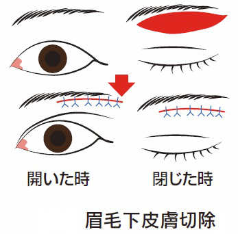 眉毛下皮膚切除イラスト