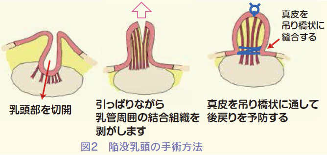 陥没乳頭の手術方法イラスト