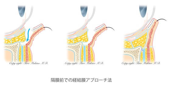 くま手術法イラスト