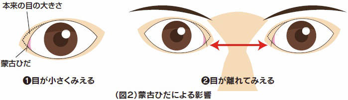 蒙古ひだ影響イラスト