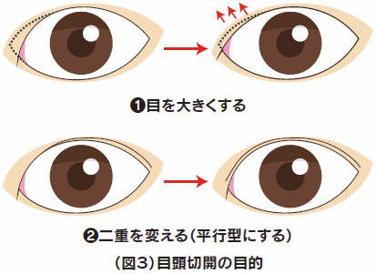 目頭切開の目的イラスト