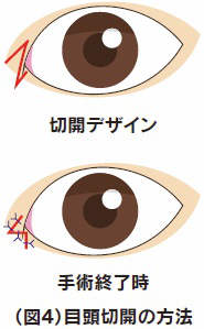 目頭切開の方法イラスト