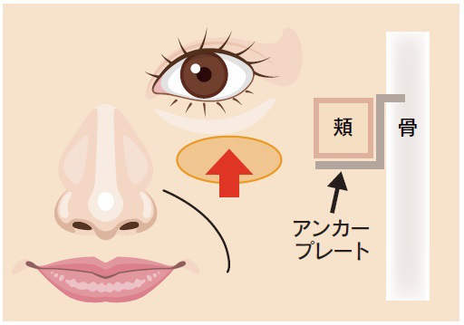 ミッドチークリフトイラスト