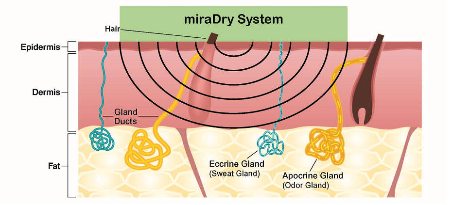ミラドライ作用イメージ１