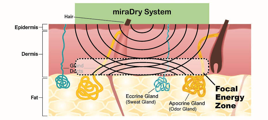 ミラドライ作用イメージ２