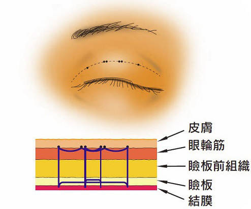 マルティプルノット法のイラスト