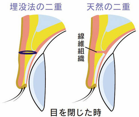 天然の二重と埋没法による二重の構造イラスト