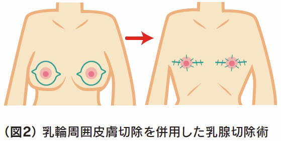 皮膚のたるみが中等度の場合の乳輪周囲皮膚切除の追加イラスト