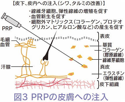 PRPの皮膚への注入