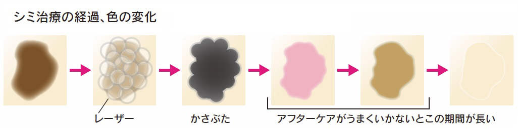 シミ治療の経過、色の変化イラスト