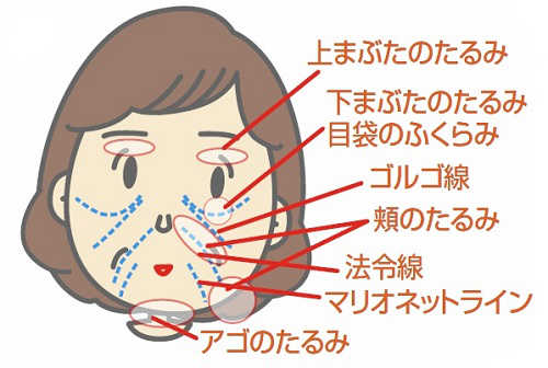 お顔のたるみイラスト