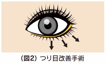 つり目改善イラスト