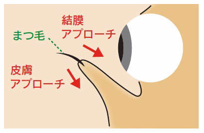 下眼瞼下制術イラスト